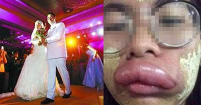 泰國女孩嫁中國小夥，新婚第二天變「香腸嘴」，醫生的話讓他們很尷尬